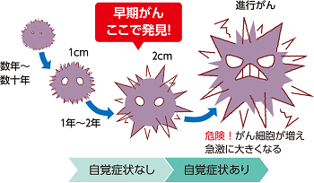 がんのステージの進行と危険性の解説図