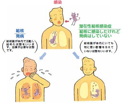 感染と発病のちがい